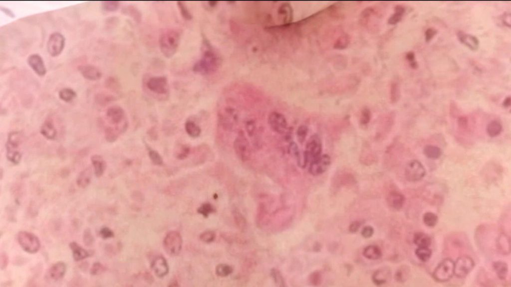 “Ontario’s Favorite Summer Getaway Leads in New Measles Outbreaks This Week!”